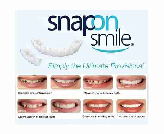 Snap-On Smile | Perfect Smile Teeth Veneer 36 Pieces