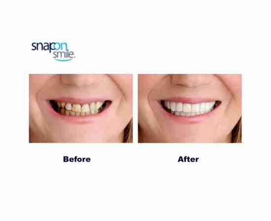 Snap-On Smile | Perfect Smile Teeth Veneer 36 Pieces